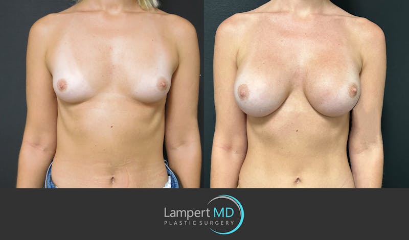 Breast Augmentation result at Dr. Joshua Lampert Plastic Surgery