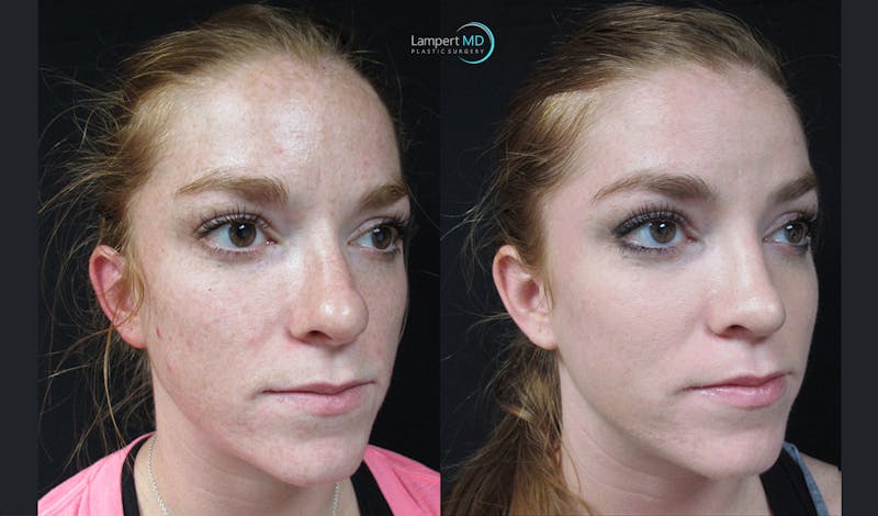 Rhinoplasty result at Dr. Joshua Lampert Plastic Surgery