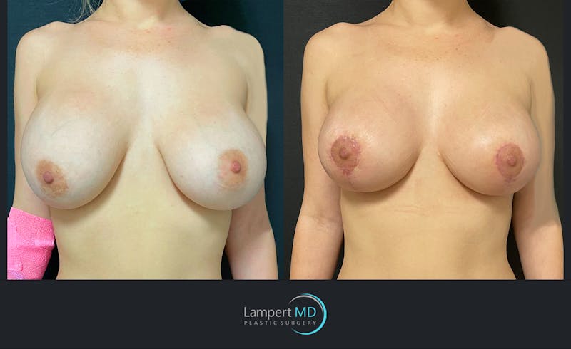 Implant Revision result at Dr. Joshua Lampert Plastic Surgery