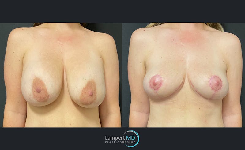 Breast Lift result at Dr. Joshua Lampert Plastic Surgery