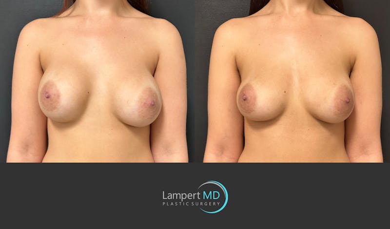 Implant Revision result at Dr. Joshua Lampert Plastic Surgery