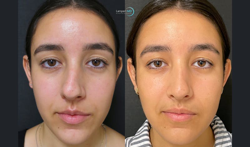 Rhinoplasty result at Dr. Joshua Lampert Plastic Surgery
