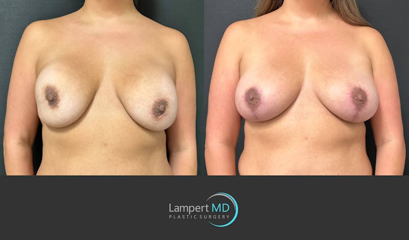 Implant Revision result at Dr. Joshua Lampert Plastic Surgery