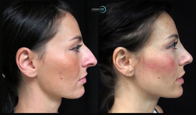 Rhinoplasty result at Dr. Joshua Lampert Plastic Surgery