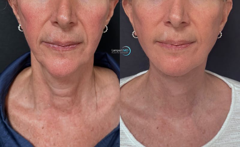 Facelift result at Dr. Joshua Lampert Plastic Surgery