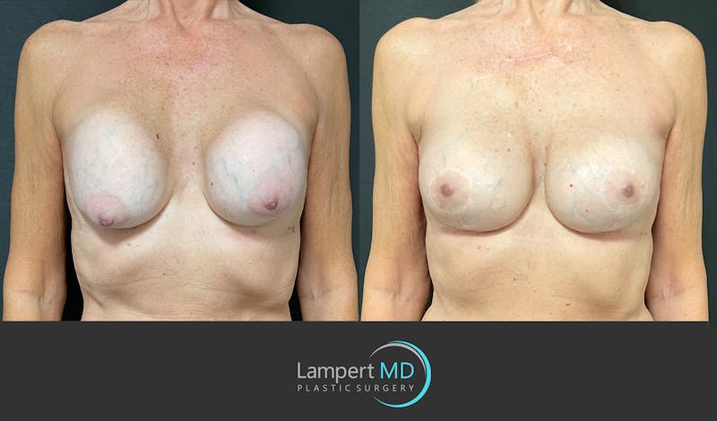 Implant Revision result at Dr. Joshua Lampert Plastic Surgery