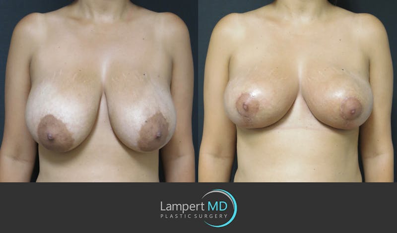 Breast Lift result at Dr. Joshua Lampert Plastic Surgery