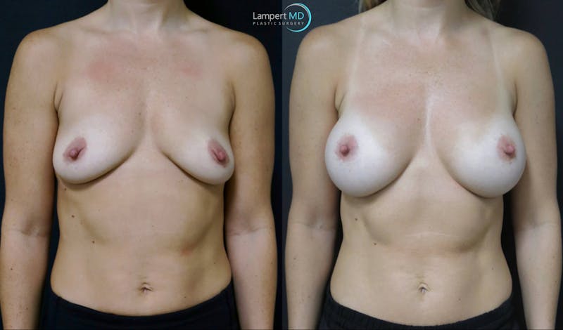 Breast Augmentation result at Dr. Joshua Lampert Plastic Surgery
