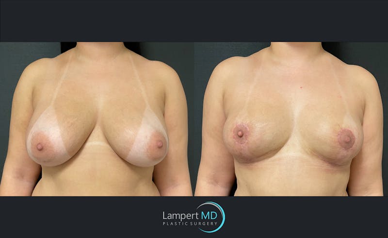 Breast Lift result at Dr. Joshua Lampert Plastic Surgery