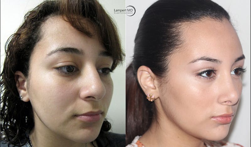 Rhinoplasty result at Dr. Joshua Lampert Plastic Surgery