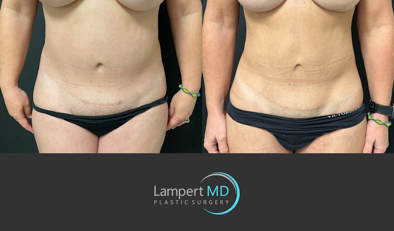 Liposuction result at Dr. Joshua Lampert Plastic Surgery