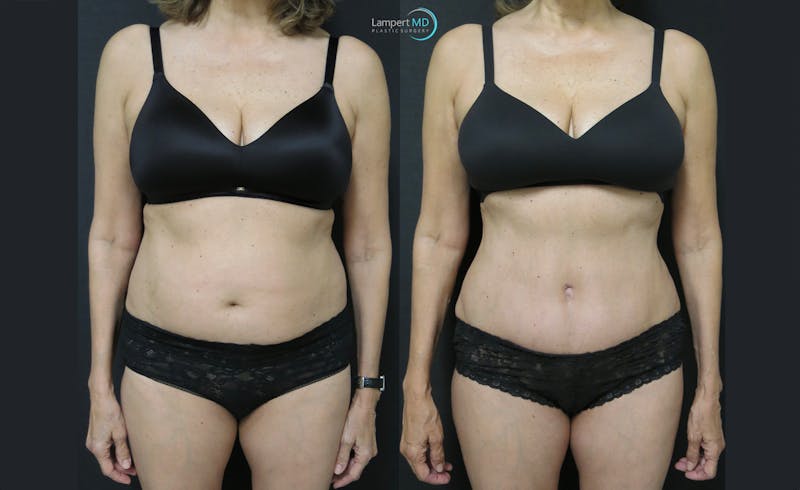 Mommy Makeover result at Dr. Joshua Lampert Plastic Surgery