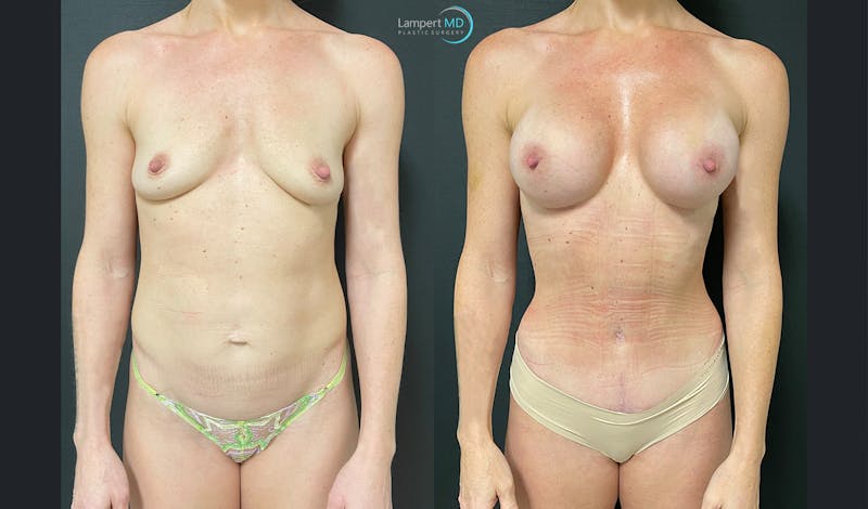 Mommy Makeover result at Dr. Joshua Lampert Plastic Surgery