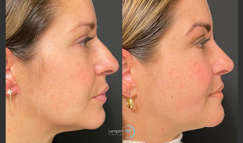 Rhinoplasty result at Dr. Joshua Lampert Plastic Surgery