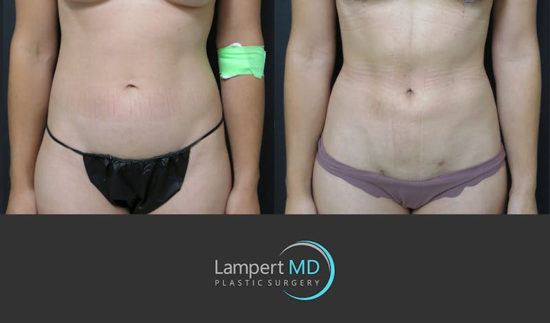 Liposuction result at Dr. Joshua Lampert Plastic Surgery