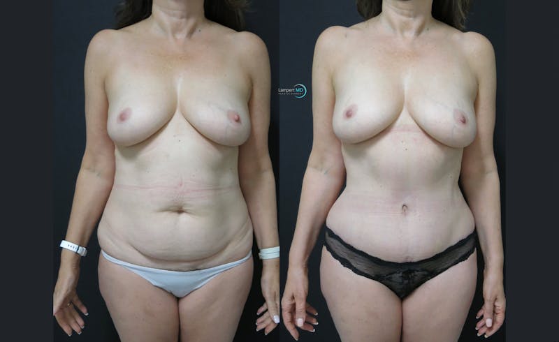 Tummy Tuck result at Dr. Joshua Lampert Plastic Surgery