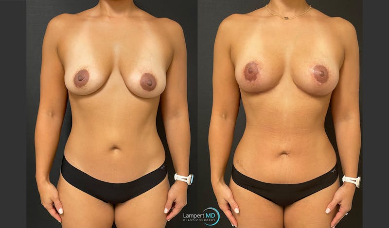 Tummy Tuck result at Dr. Joshua Lampert Plastic Surgery
