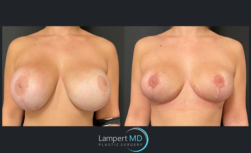 Breast Lift result at Dr. Joshua Lampert Plastic Surgery