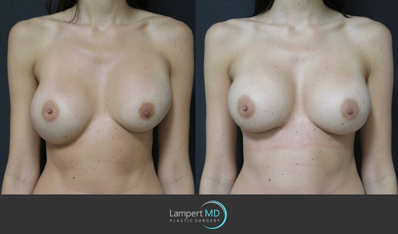 Breast Augmentation result at Dr. Joshua Lampert Plastic Surgery