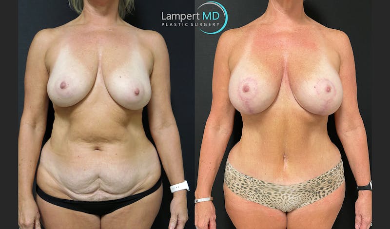 Mommy Makeover result at Dr. Joshua Lampert Plastic Surgery