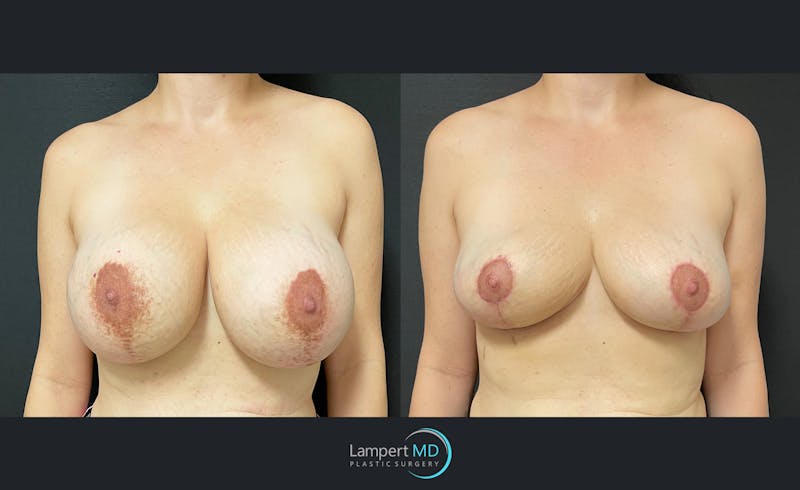 Breast Lift result at Dr. Joshua Lampert Plastic Surgery