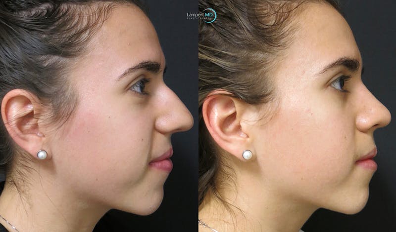 Rhinoplasty result at Dr. Joshua Lampert Plastic Surgery