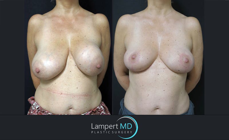 Breast Lift result at Dr. Joshua Lampert Plastic Surgery