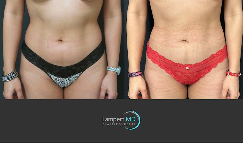 Liposuction result at Dr. Joshua Lampert Plastic Surgery