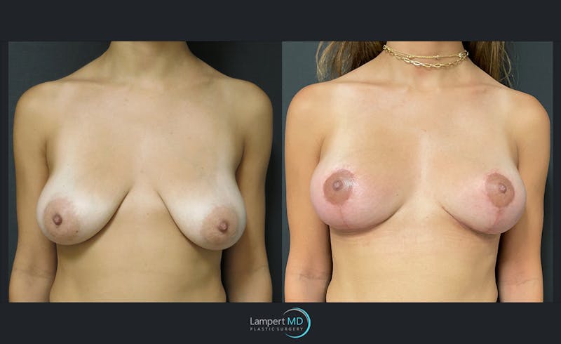 Breast Lift result at Dr. Joshua Lampert Plastic Surgery