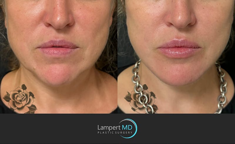 Facelift result at Dr. Joshua Lampert Plastic Surgery