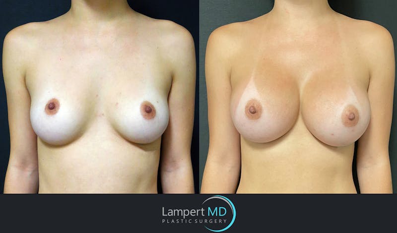 Breast Augmentation result at Dr. Joshua Lampert Plastic Surgery