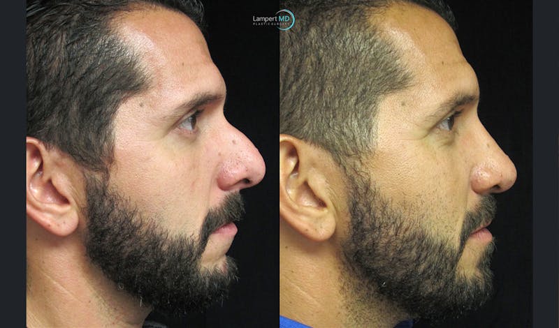 Rhinoplasty result at Dr. Joshua Lampert Plastic Surgery