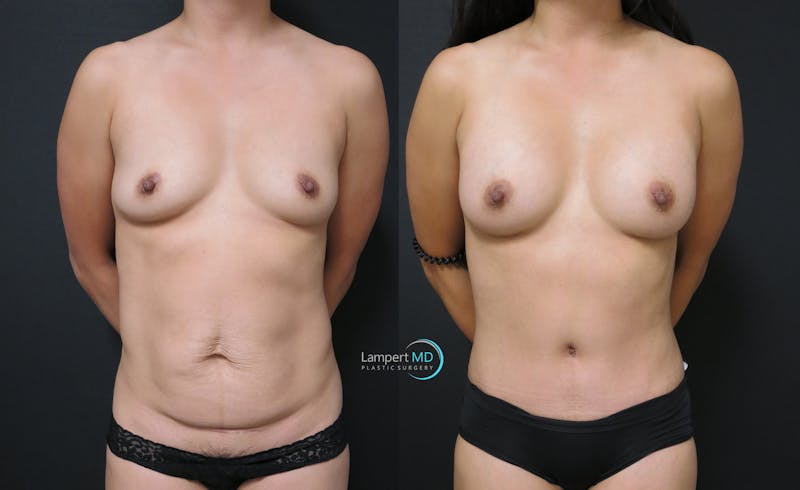 Mommy Makeover result at Dr. Joshua Lampert Plastic Surgery