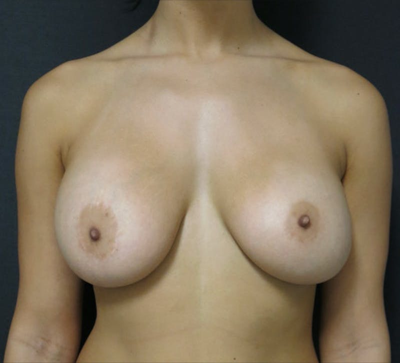 Breast Augmentation result at Dr. Joshua Lampert Plastic Surgery