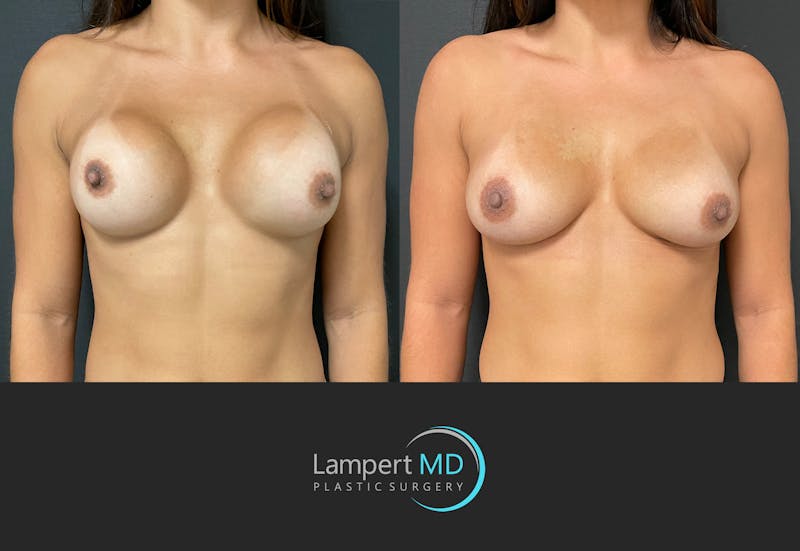 Implant Revision result at Dr. Joshua Lampert Plastic Surgery