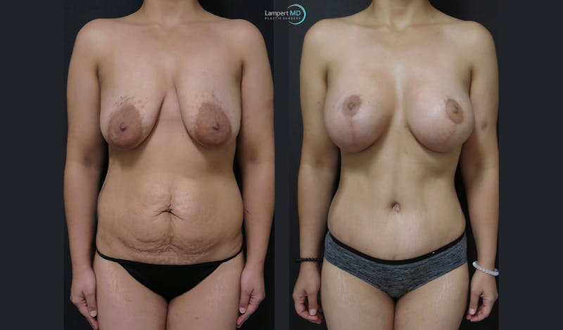Mommy Makeover result at Dr. Joshua Lampert Plastic Surgery