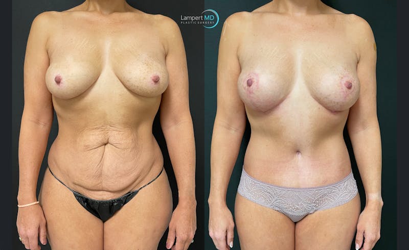 Tummy Tuck result at Dr. Joshua Lampert Plastic Surgery