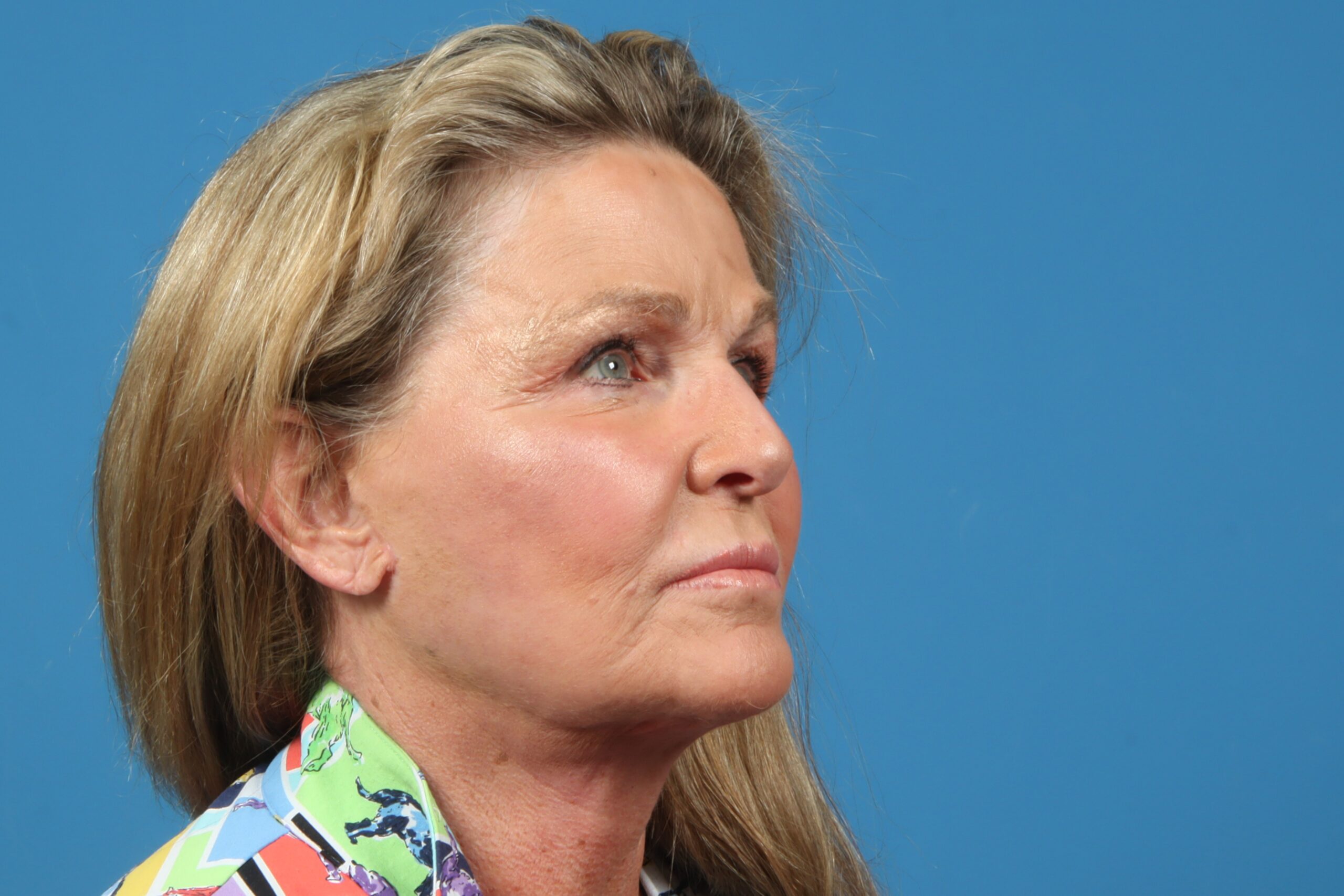 A result from Plastic Surgery Associates