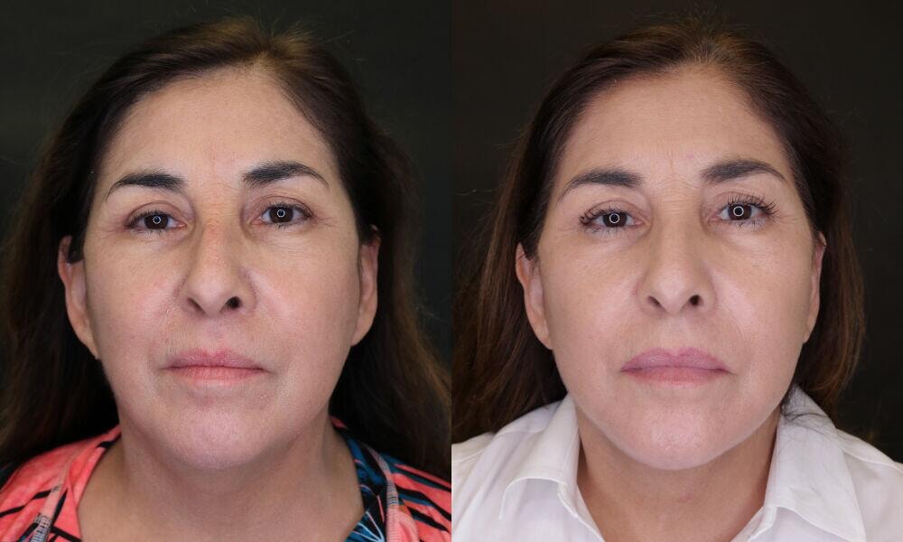 A result from Jose Rodríguez-Feliz, MD
