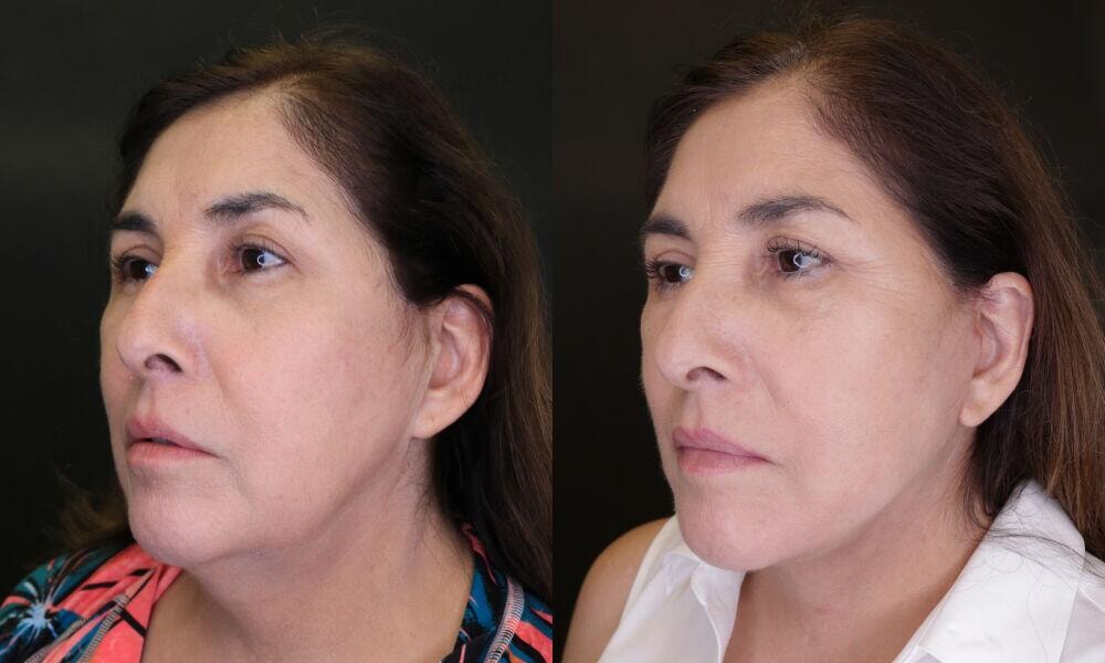 A result from Jose Rodríguez-Feliz, MD