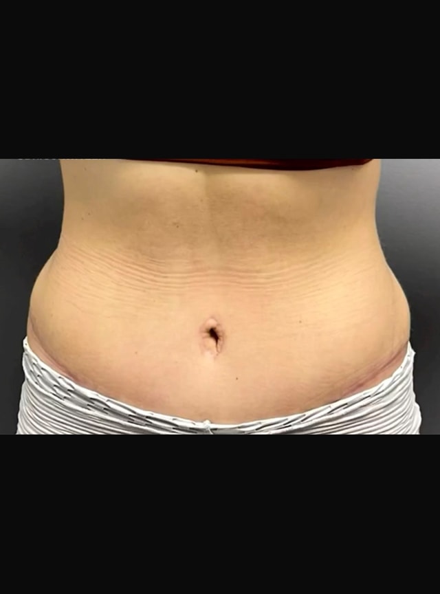 A result from Jonathan A. Schwitzer, MD Plastic Surgery