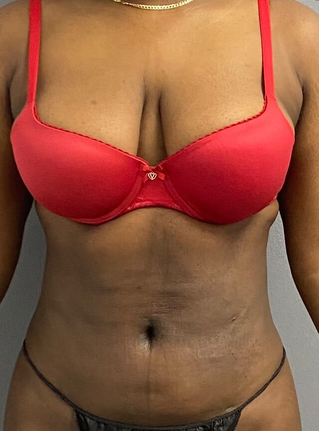 A result from Jonathan A. Schwitzer, MD Plastic Surgery