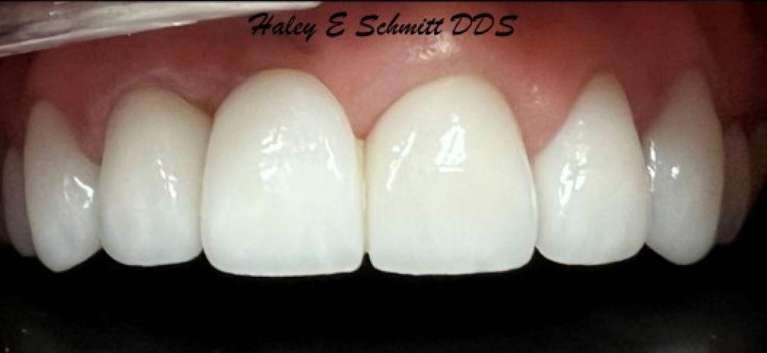 A result from Haley E. Schmitt, DDS Cosmetic & Family Dentistry