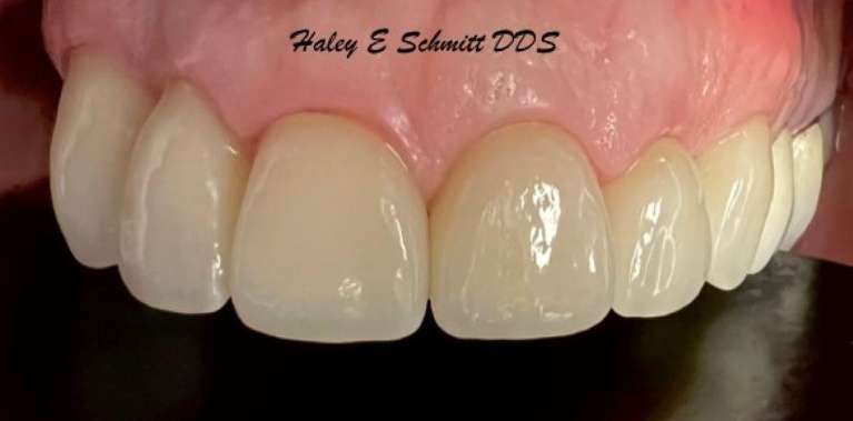 A result from Haley E. Schmitt, DDS Cosmetic & Family Dentistry