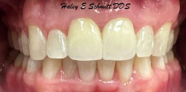 A result from Haley E. Schmitt, DDS Cosmetic & Family Dentistry