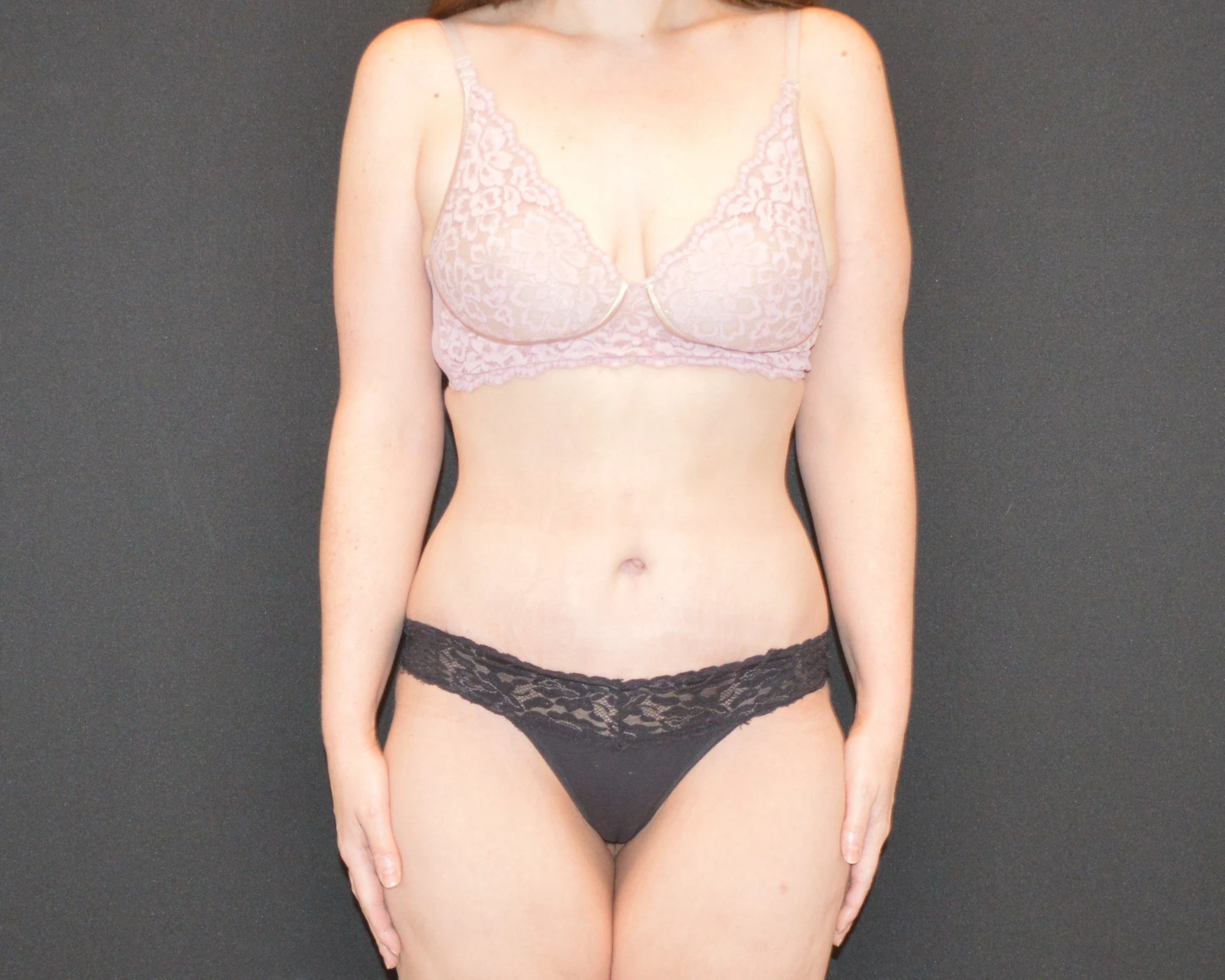 A result from Campanile Plastic Surgery