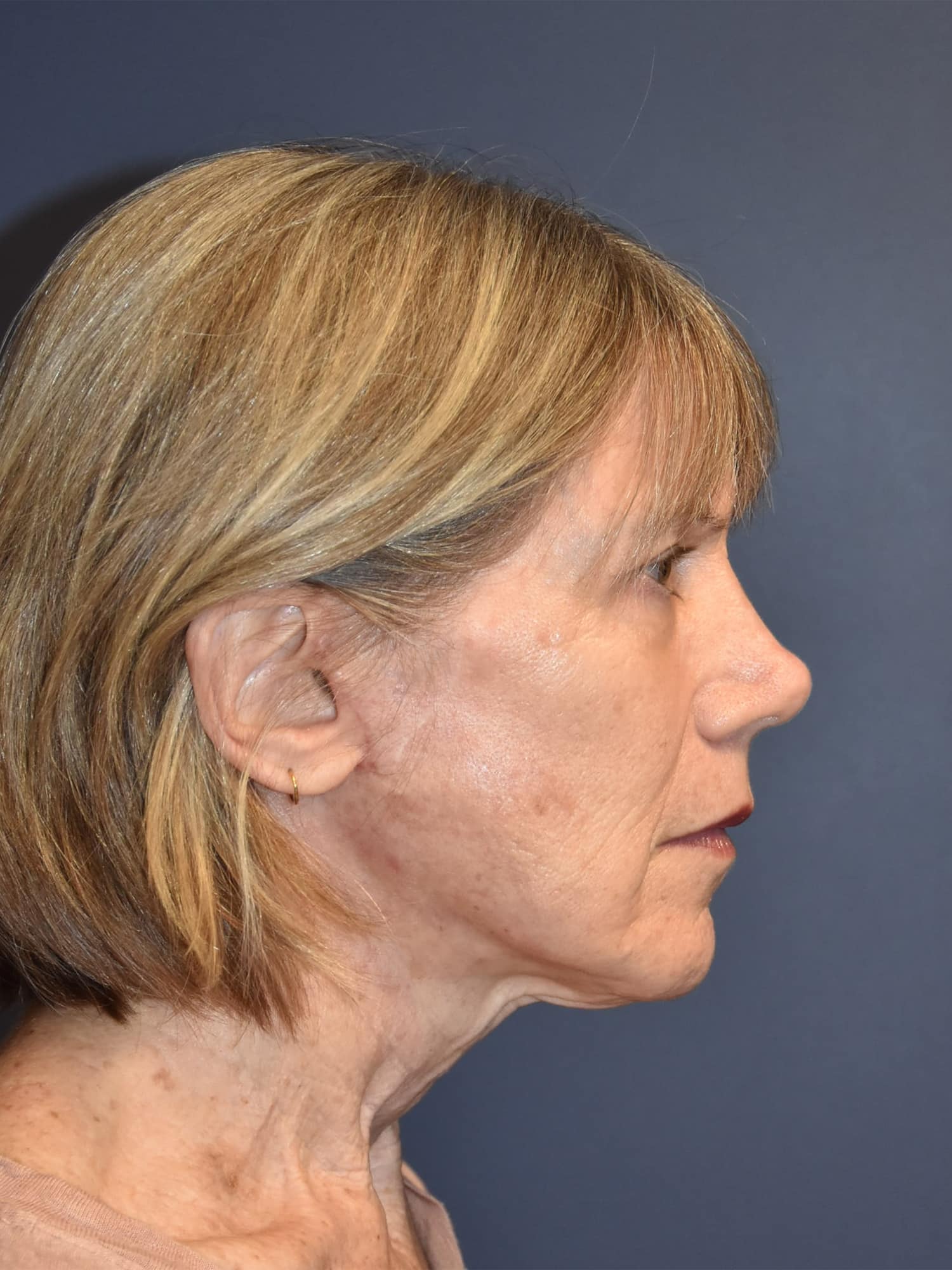 A result from Samuel Lin, MD, FACS