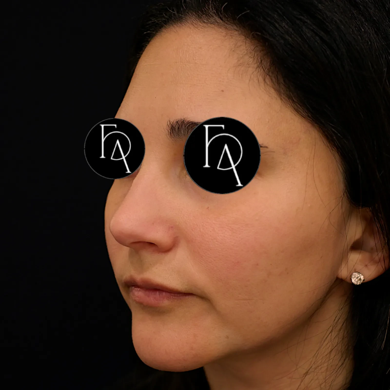 A result from Fulcrum Aesthetics and Surgery