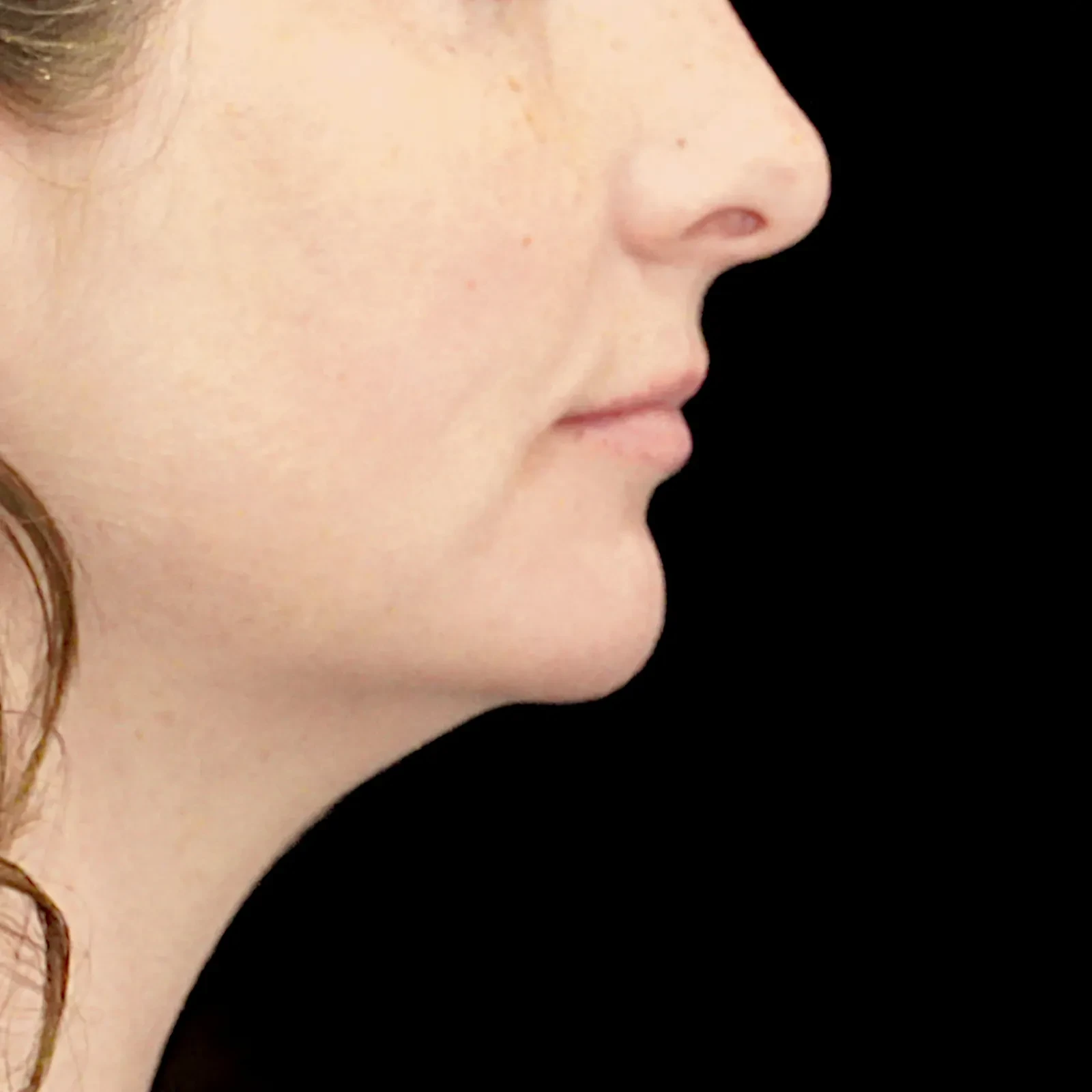 A result from Fulcrum Aesthetics and Surgery