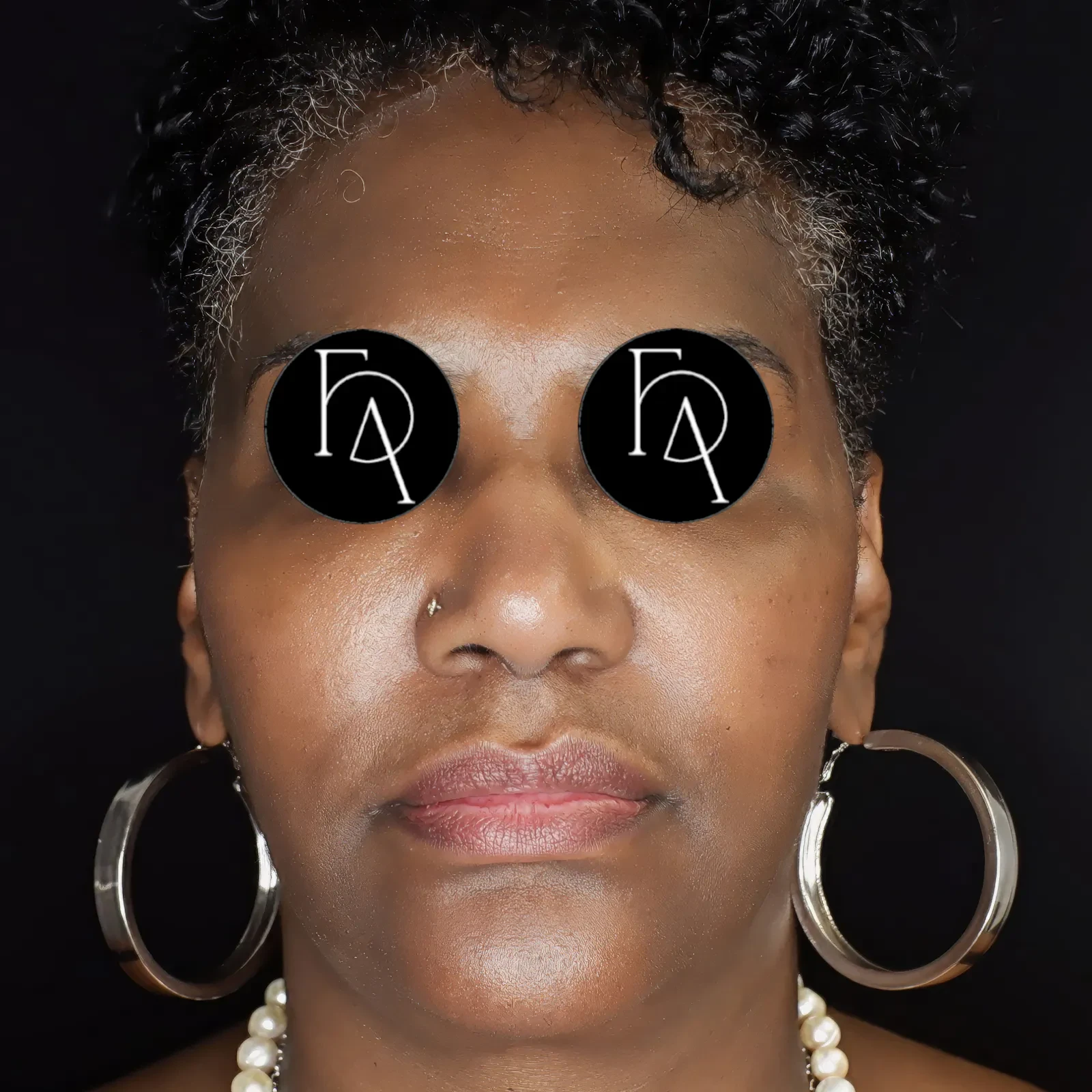 A result from Fulcrum Aesthetics and Surgery